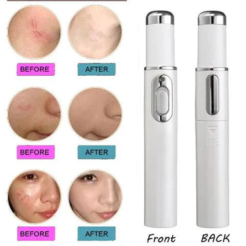 Blue Light Therapy Acne Laser Pen - Scar & Blemish Reduction - Skincare Lab